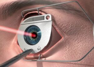 Как проводится лазерная коррекция зрения?