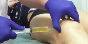 Применение синовиальной жидкости в уколах для лечения суставов